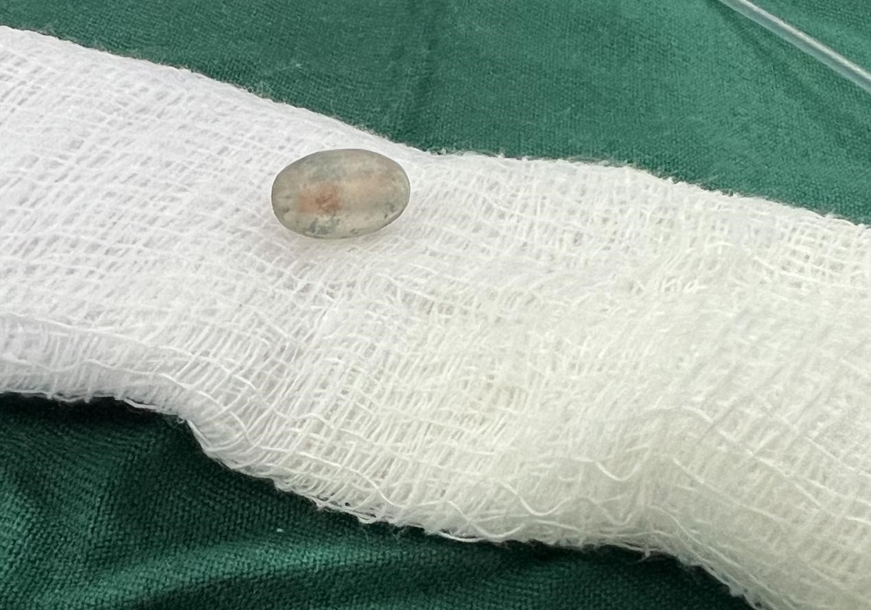 被取出的異物。中國(guó)援桑醫(yī)療隊(duì)供圖